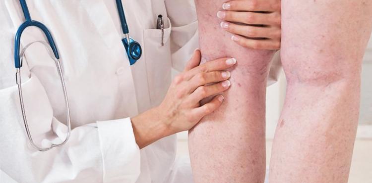 Cão edema insuficiência cardíaca
