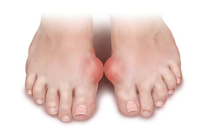 Prevenir e tratar a gota