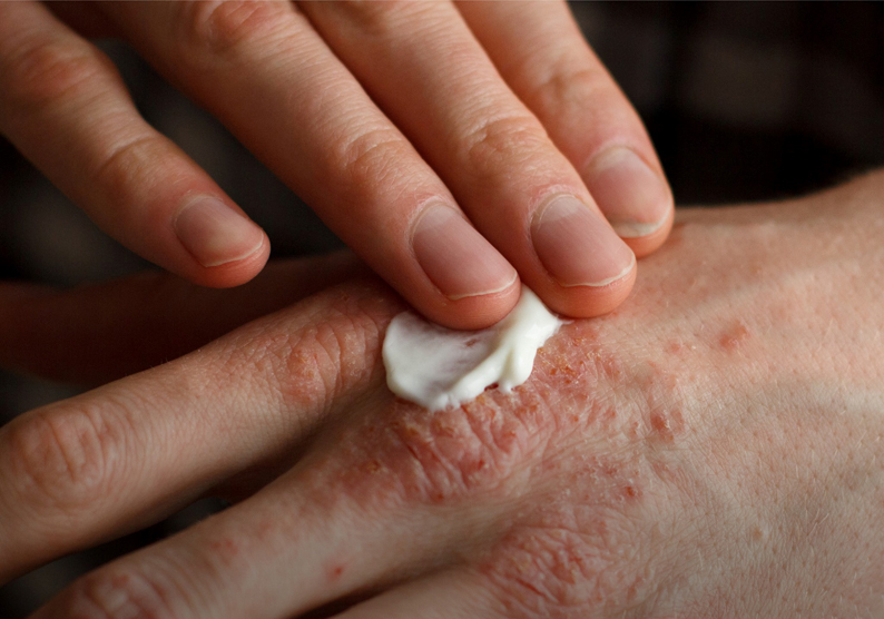 Conhecer a Psoríase